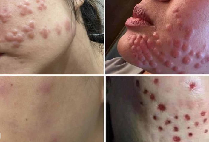Rủi ro khi tiêm meso tại các cơ sở kém chất lượng