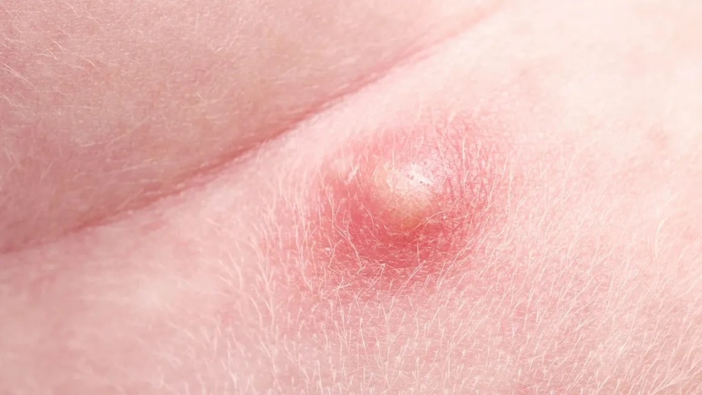 Mụn bọc thường sưng đỏ v&agrave; nhức