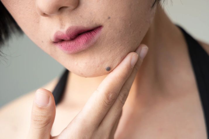 Nốt ruồi l&agrave; g&igrave;