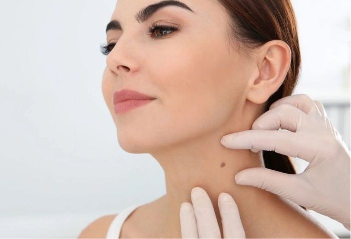 Nốt ruồi l&agrave; g&igrave;?