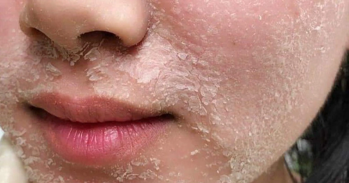 Sau khi peel da thường c&oacute; t&igrave;nh trạng bong tr&oacute;c v&agrave; ửng đỏ