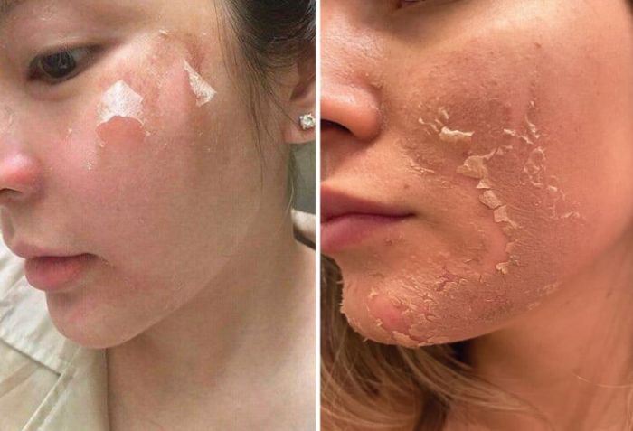 Lạm dụng các phương pháp làm đẹp xâm lấn