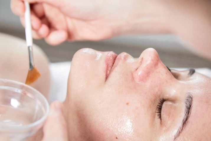 Peel da n&ocirc;ng (Light Chemical Peel)