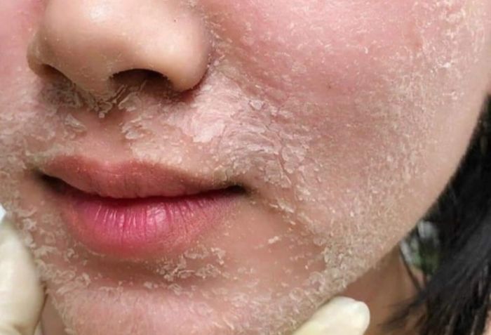 Peel da s&acirc;u (Deep Chemical Peel)