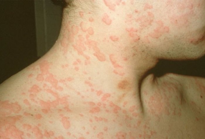 Dị ứng với hoạt chất ti&ecirc;m