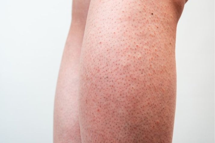Rủi ro khi triệt l&ocirc;ng