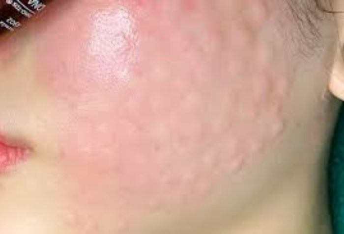 Sưng đỏ v&agrave; bầm t&iacute;m tại vị tr&iacute; ti&ecirc;m