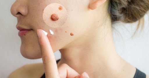 Loại bỏ mụn thịt bằng thuốc b&ocirc;i