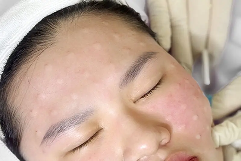 Ti&ecirc;m meso được ph&aacute;i đẹp tin d&ugrave;ng để n&acirc;ng cấp l&agrave;n da