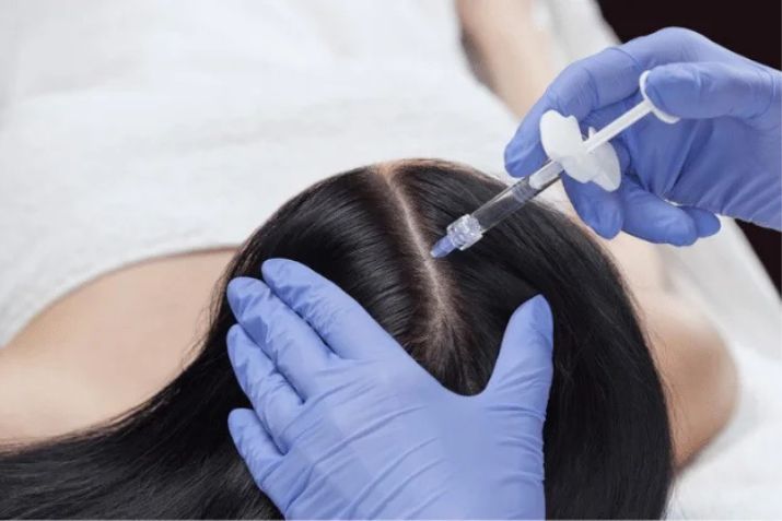 Ti&ecirc;m meso trị rụng t&oacute;c tại Pro Skin