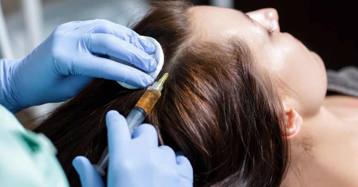 Ti&ecirc;m meso trị rụng t&oacute;c