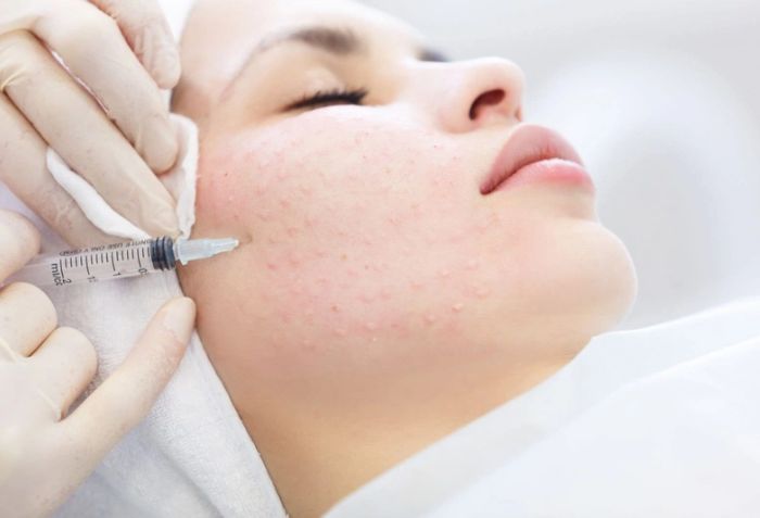 Tiêm meso là gì? Những ai nên thực hiện liệu pháp này?