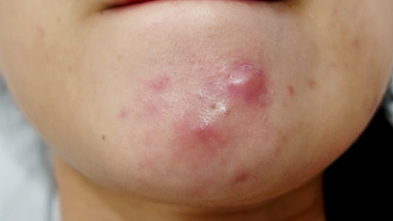 T&igrave;nh trạng da bị mụn