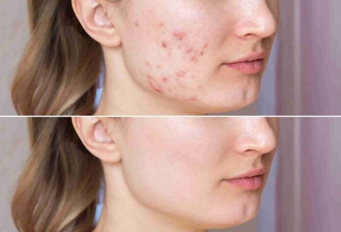 Kiểm so&aacute;t dầu nhờn v&agrave; mụn