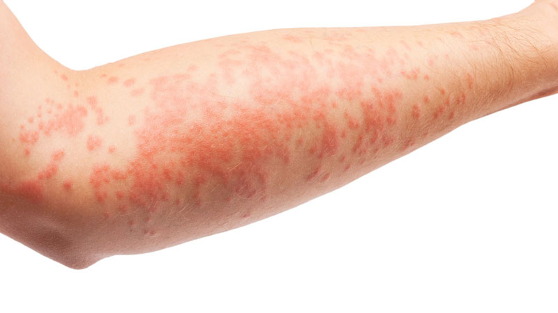 Vi&ecirc;m da dị ứng thời tiết l&agrave; g&igrave;