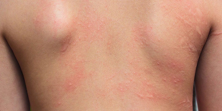 Vi&ecirc;m da tiếp x&uacute;c