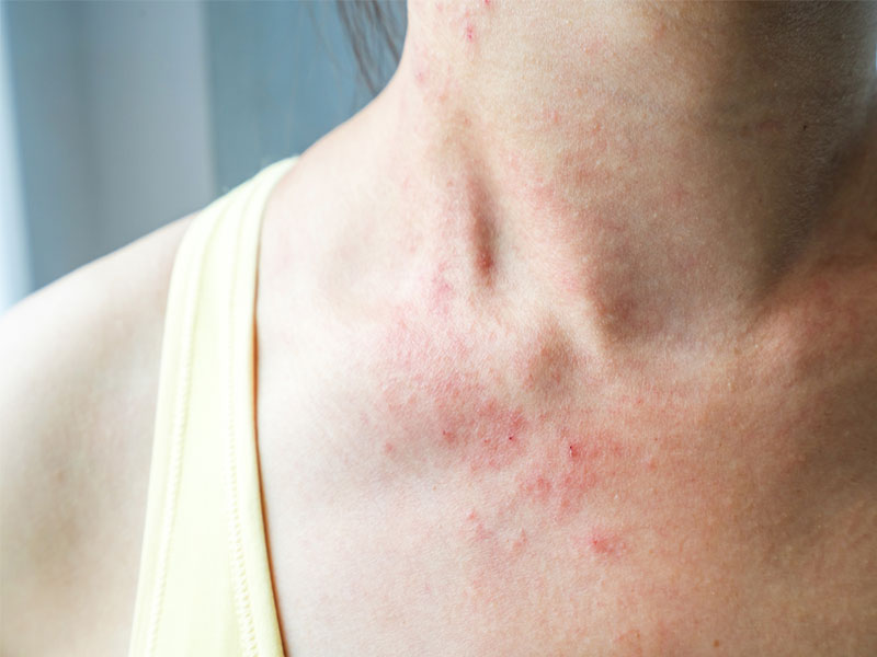 Triệu chứng vi&ecirc;m da dị ứng thời tiết