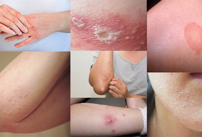 Vi&ecirc;m da l&agrave; g&igrave;? Tại sao cần phải điều trị vi&ecirc;m da kịp thời?