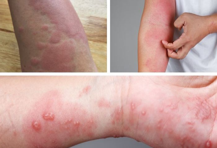 C&aacute;c bệnh l&yacute; thường gặp khi kh&aacute;m da liễu