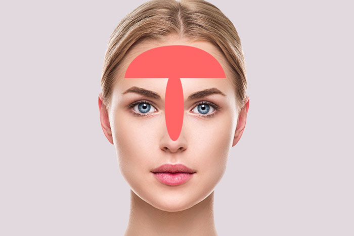 V&ugrave;ng chữ T đổ dầu nhiều tr&ecirc;n mặt