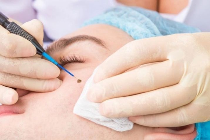 X&oacute;a nốt ruồi bằng Laser Fractional CO2